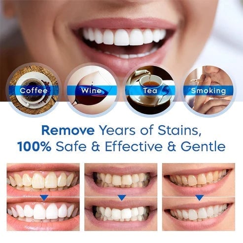 LAST DAY 49%OFF - Teeth Whitening Pens