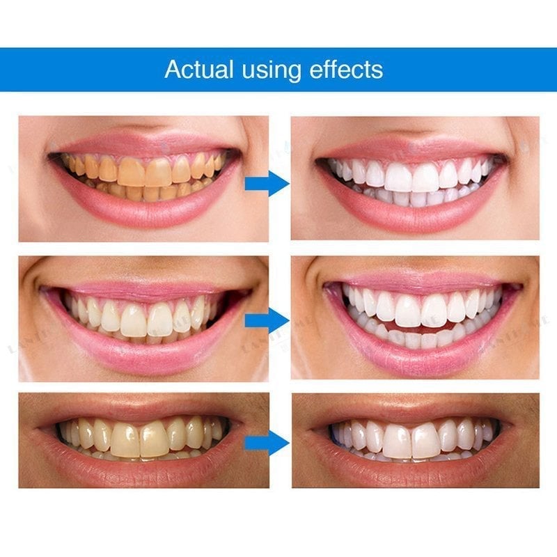 LAST DAY 49%OFF - Teeth Whitening Pens